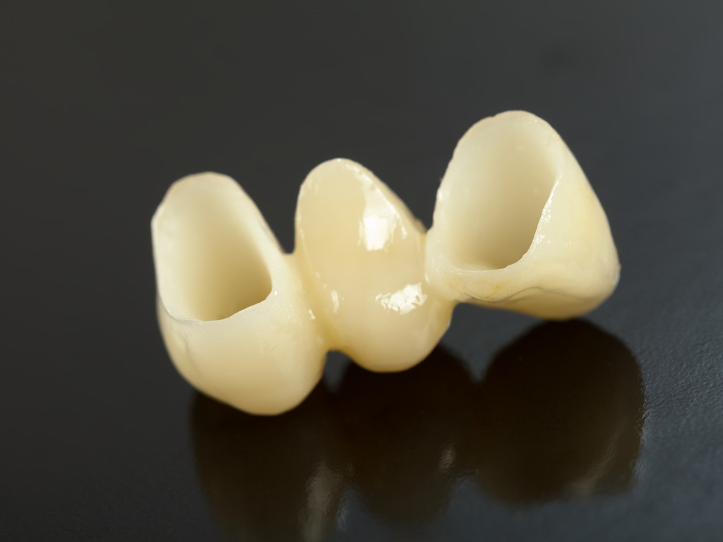 bridge dentaire tout ceramique