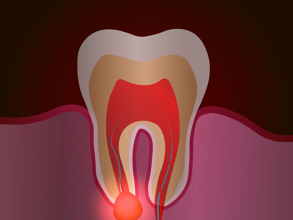 abces dentaire a la racine de la dent