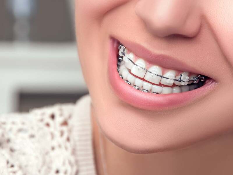 orthodontie_adolescent_2